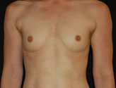 Patient # 35211 Before Photo # 1